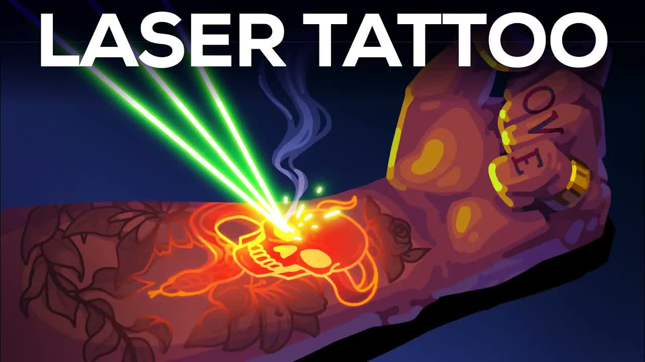 Tattoo Removal Is Insane