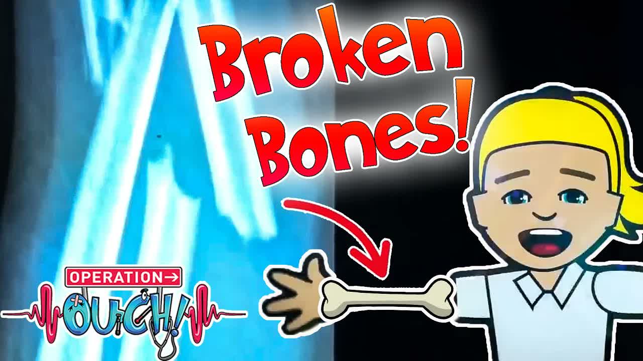 Broken Bones and Plaster Casts! 🦴 | Science for Kids | Operation Ouch